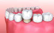 Dental Crowns Improve The Look of Damaged Teeth! 